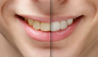 A before and after photo showing the benefits of teeth whitening.
